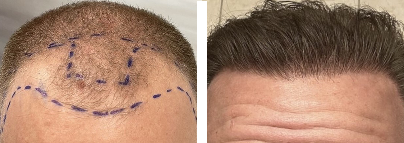 hairrestoration