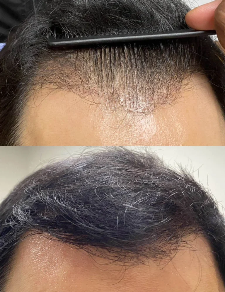 hairrestorationintro-1-768×996