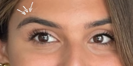 botoxbxaafter-460×230